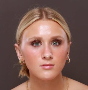 Otoplasty by Dr. Manning