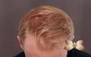 FUE Hair Transplant by Dr, Henstrom