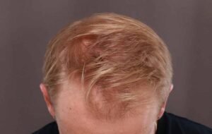 FUE Hair Transplant by Dr, Henstrom