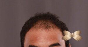 FUE Hair Transplant by Dr. Manning