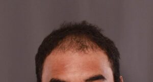 FUE Hair Transplant by Dr. Manning