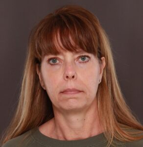 Lower Blepharoplasty with Fat Grafting by Dr. Thompson