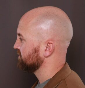 Rhinoplasty by Dr. Thompson