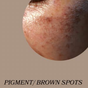 BROWN SPOTS