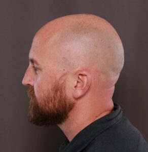 Rhinoplasty by Dr. Thompson