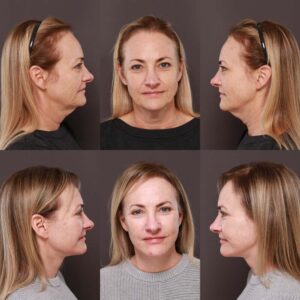 facelift results 