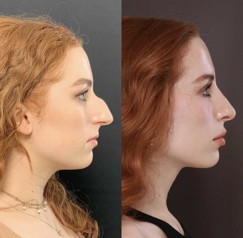 Natural vs. Dramatic Rhinoplasty: Which is Better? - Utah Facial Plastics