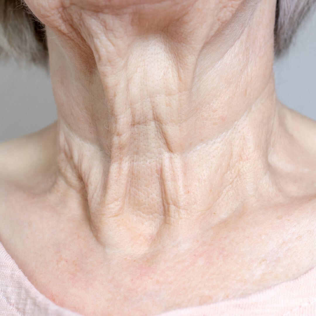 Cómo arreglar su cuello de pavo para siempre Utah Facial Plastics