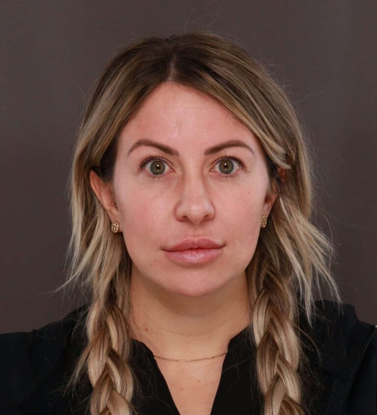 Before Image: Upper Blepharoplasty by Dr. Henstrom - front