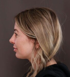 Upper Blepharoplasty by Dr. Henstrom