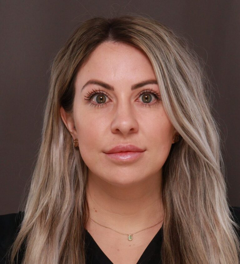 After Image: Upper Blepharoplasty by Dr. Henstrom - front