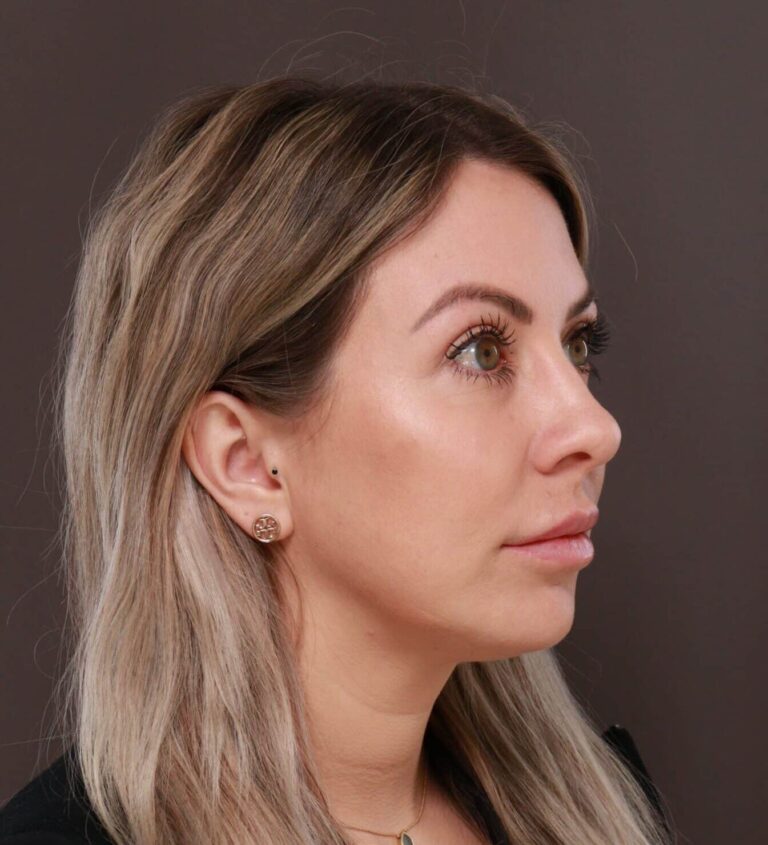 After Image: Upper Blepharoplasty by Dr. Henstrom - right-front-oblique