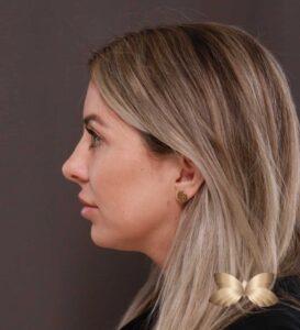 Upper Blepharoplasty by Dr. Henstrom