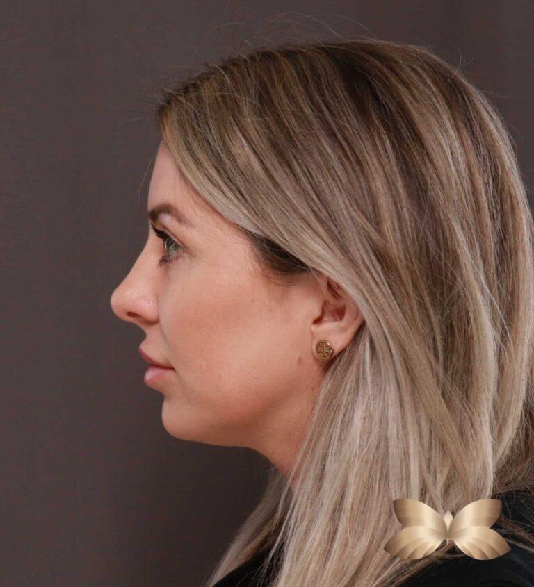 After Image: Upper Blepharoplasty by Dr. Henstrom - left-side