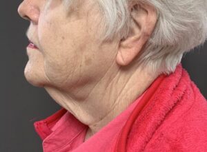 Direct Necklift by Dr. Henstrom