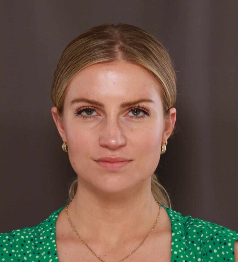 After Image: Rhinoplasty by Dr. Thompson - front