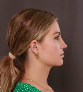 Rhinoplasty by Dr. Thompson