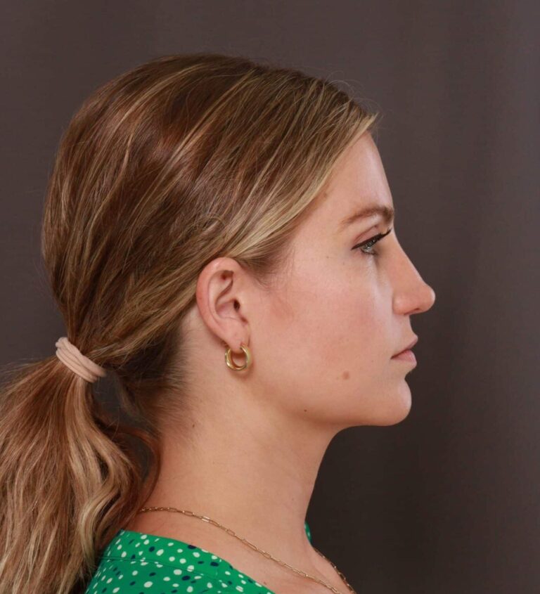 After Image: Rhinoplasty by Dr. Thompson - right-side