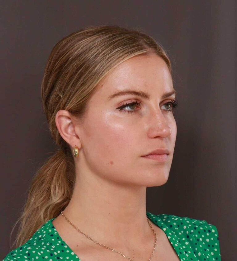 After Image: Rhinoplasty by Dr. Thompson - right-front-oblique