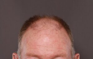 FUT Hair Transplant by Dr. Manning
