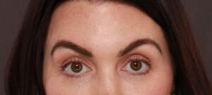 Eyebrow Hair Transplant by Dr. Manning