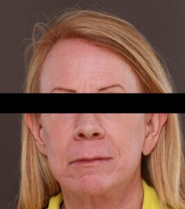 Facelift & Blepharoplasty by Dr. Henstrom, Contour TRL Laser Resurfacing by Dr. Katy Larson