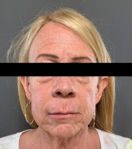 Facelift & Blepharoplasty by Dr. Henstrom, Contour TRL Laser Resurfacing by Dr. Katy Larson