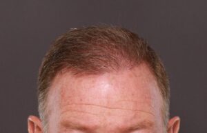 FUT Hair Transplant by Dr. Manning