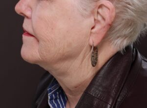 Direct Necklift by Dr. Henstrom