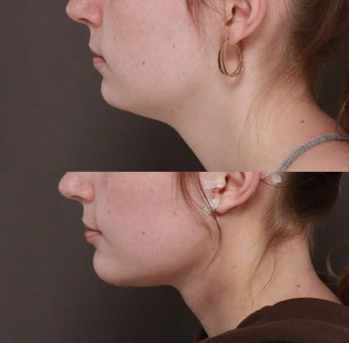 before after Direct Neck Lift surgery Draper UT