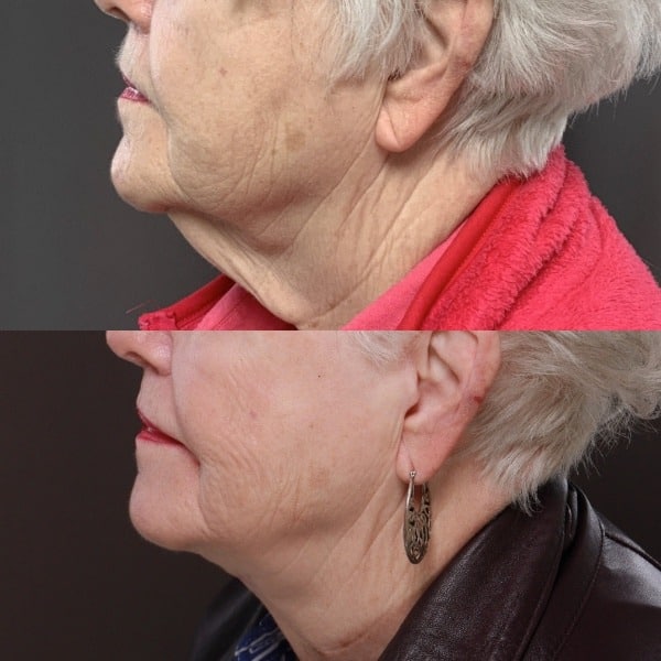 before after Direct Neck Lift surgery Draper UT