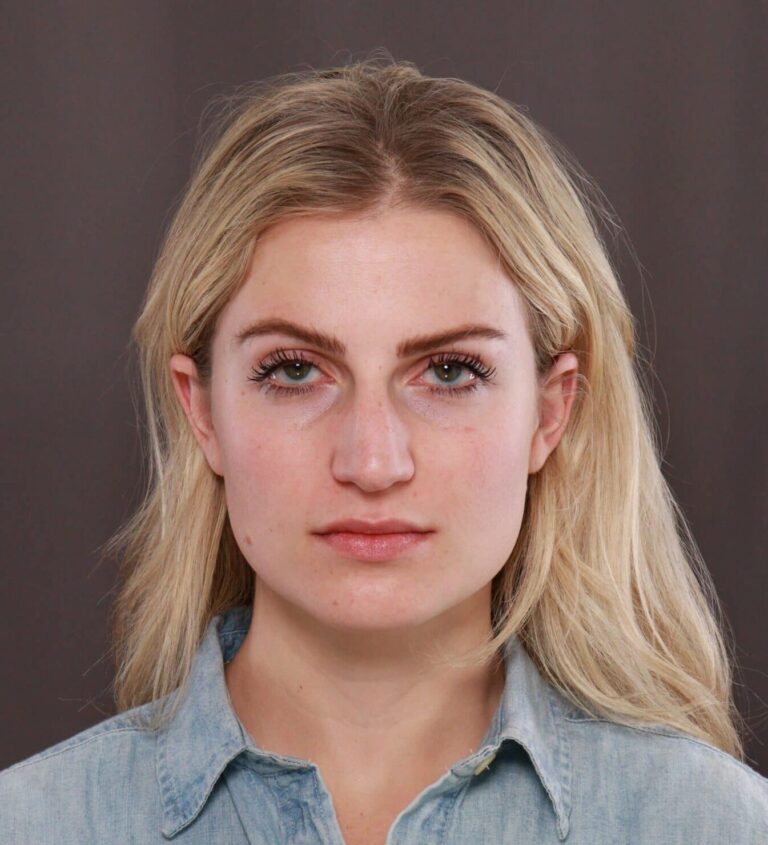 Before Image: Rhinoplasty by Dr. Thompson - front