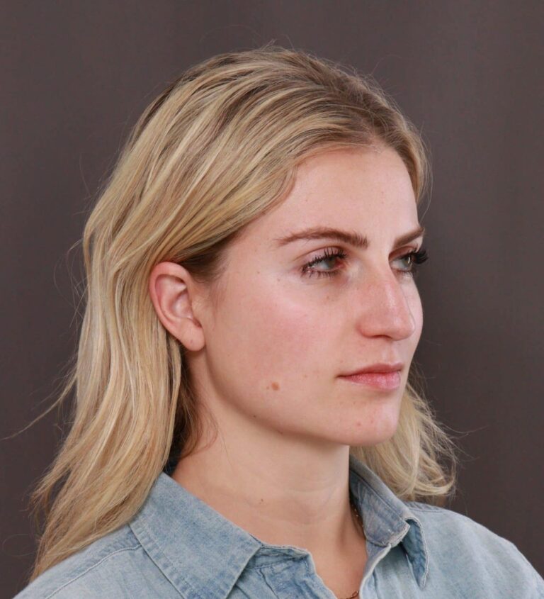 Before Image: Rhinoplasty by Dr. Thompson - right-front-oblique
