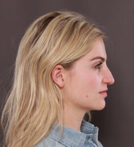 Rhinoplasty by Dr. Thompson