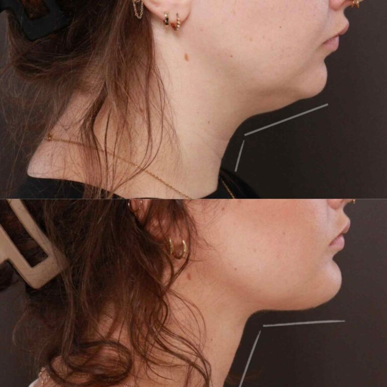 before after Direct Neck Lift Salt Lake City UT