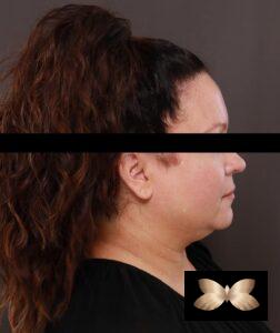 Facelift by Dr. Thompson