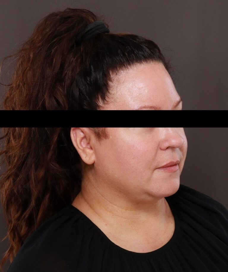 Before Image: Facelift by Dr. Thompson - front