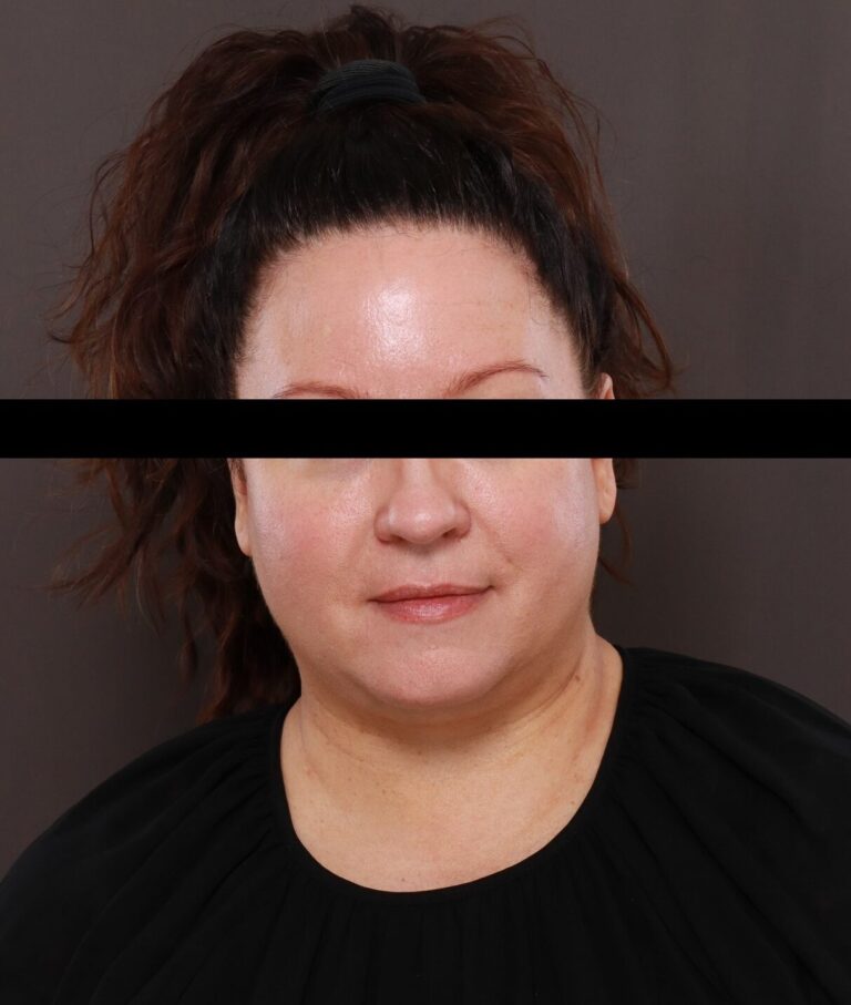 Before Image: Facelift by Dr. Thompson - front
