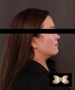 Facelift by Dr. Thompson
