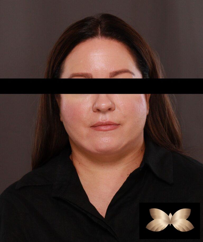 After Image: Facelift by Dr. Thompson - front