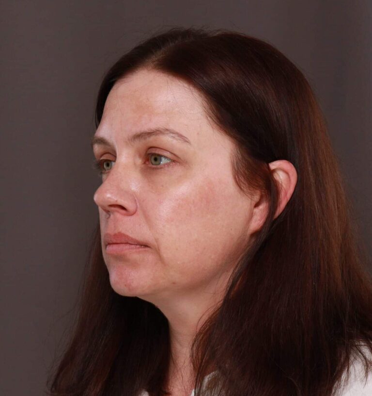 Before Image: Halo & Moxi STaX Treatment - left-front-oblique