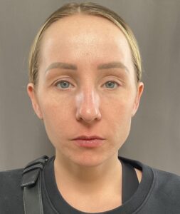 Collagen Induction Therapy, Moxi, & BBL