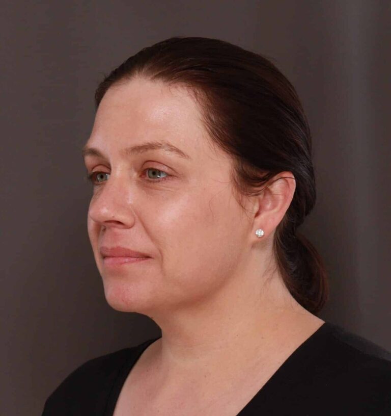 After Image: Halo & Moxi STaX Treatment - left-front-oblique