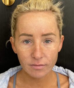 Collagen Induction Therapy, Moxi, & BBL
