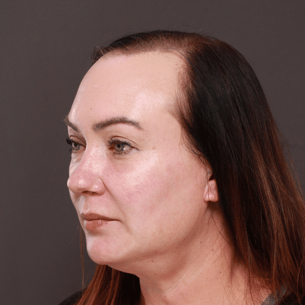 After Image: Moxi & BBL Skin Resurfacing - left-front-oblique