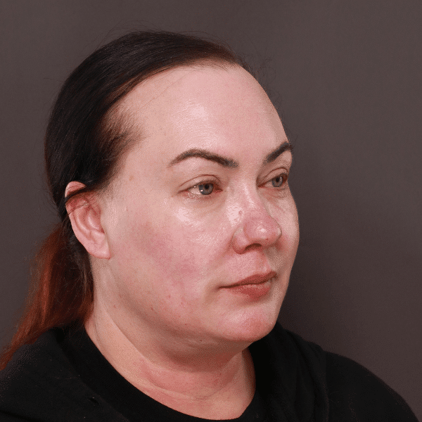 Before Image: Moxi & BBL Skin Resurfacing - right-front-oblique