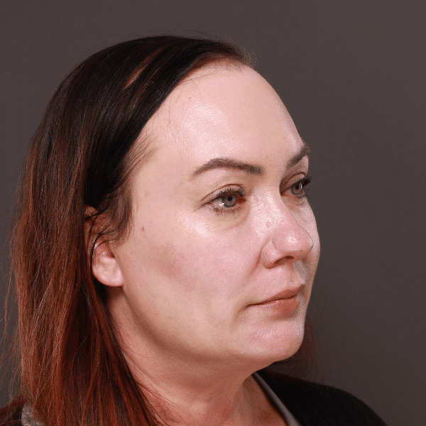 After Image: Moxi & BBL Skin Resurfacing - right-front-oblique