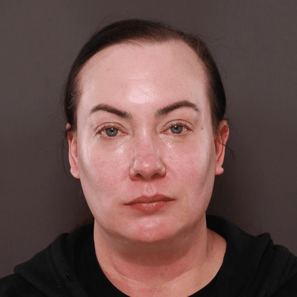 Before Image: Moxi & BBL Skin Resurfacing - front