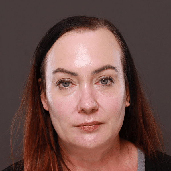 After Image: Moxi & BBL Skin Resurfacing - front