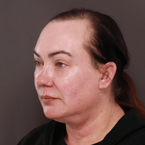 Before Image: Moxi & BBL Skin Resurfacing - left-front-oblique